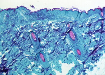 원숭이 두창 바이러스에 감염된 원숭이 피부의 병변에서 채취한 피부 조직의 현미경 모습. 사진 / 로이터