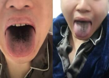 중국 톈진에 거주하는 한 남성이 코로나19 확진 판정을 받은 뒤 혀가 검게 변했다고 주장했다. 중국 웨이보 캡처