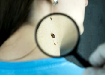 조지아 '흑색종' 발병률 높다
