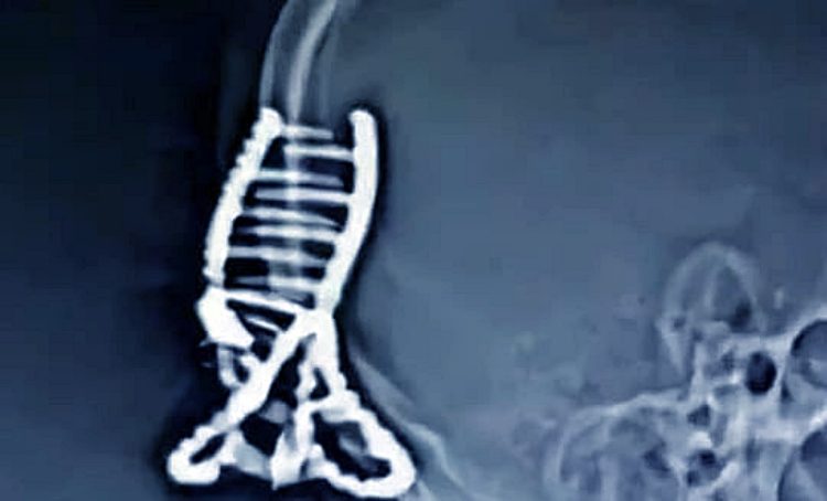 사고나면 흉기 된다…헤어 집게핀 때문에 식물인간 된 中여성