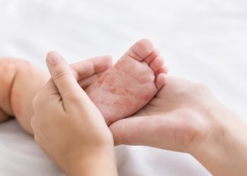 아기 발에 홍역 발진이 생긴 모습. [출처 셔터스톡]