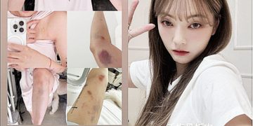 대만 인플루언서 류리잉이 자신의 소셜미디어에 올린 사진. 류리잉은 자신이 홍대에서 모르는 남성들에게 폭행당했다고 주장했다. SNS 캡처