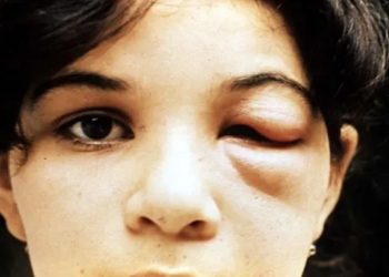 미국 특히 남부지역에서  ‘키싱 버그’를 매개로 한 샤가스병이 확산하고 있다. 증상 중 하나인 눈꺼풀 부종이 일어난 모습.  [WHO 제공]