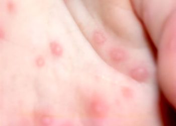 대만에서 영유아 수족구병과 신생아 패혈증 등 다양한 합병증을 유발하는 엔테로바이러스(장바이러스)가 확산하고 있다. 사진 질병관리청