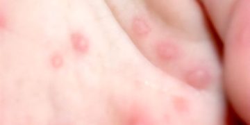 대만에서 영유아 수족구병과 신생아 패혈증 등 다양한 합병증을 유발하는 엔테로바이러스(장바이러스)가 확산하고 있다. 사진 질병관리청