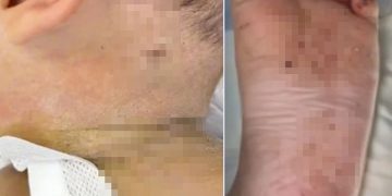 어머니에게 학대당해 수백개의 바늘 자국이 난 생후 10개월 된 아기의 모습. 사진 SCMP 캡처