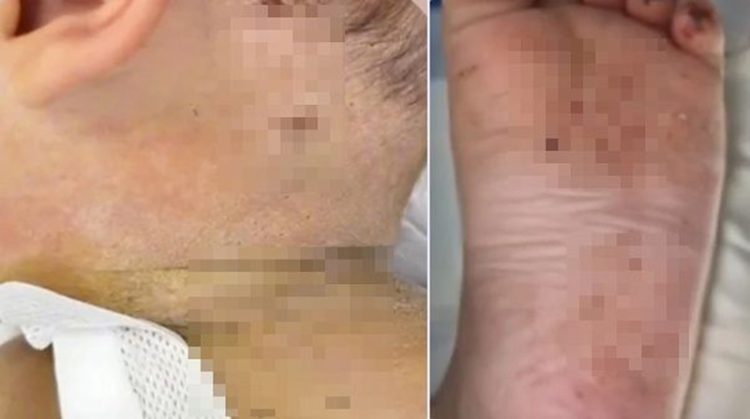 어머니에게 학대당해 수백개의 바늘 자국이 난 생후 10개월 된 아기의 모습. 사진 SCMP 캡처