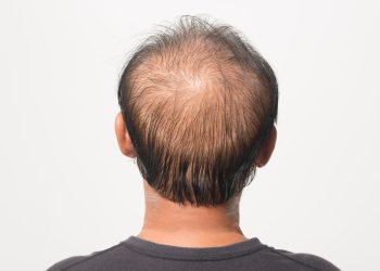 '인류의 난제' 탈모를 치료하기 위한 의약품 개발 경쟁이 올해도 치열할 전망이다. [출처 셔터스톡]