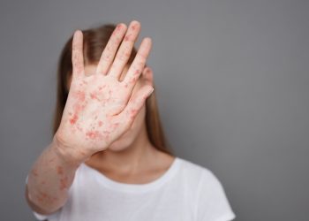 조지아에 인접한 사우스캐롤라이나주를 비롯, 전국에서 홍역이 빠르게 퍼지고 있어 한인들도 주의해야 한다. [출처 셔터스톡]