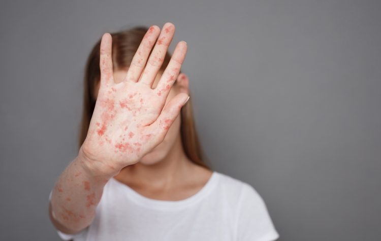 조지아에 인접한 사우스캐롤라이나주를 비롯, 전국에서 홍역이 빠르게 퍼지고 있어 한인들도 주의해야 한다. [출처 셔터스톡]