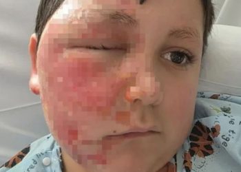 미국 9세 소년이 나도 큐브를 전자레인지에 돌렸다가 화상을 입는 사고가 발생했다. 시카고 선 타임즈