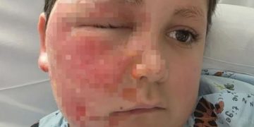 미국 9세 소년이 나도 큐브를 전자레인지에 돌렸다가 화상을 입는 사고가 발생했다. 시카고 선 타임즈