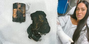 폭발한 보조배터리 잔해(왼쪽). 화상을 입은 애슐리 네벨. [인스타그램 캡처]