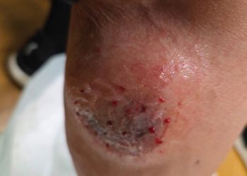 개에 물린 상처. [본인 제공]