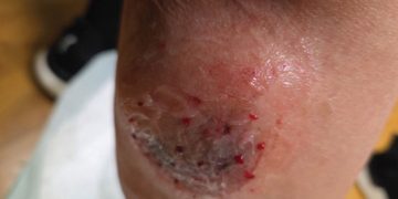 개에 물린 상처. [본인 제공]