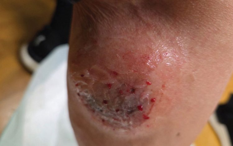 개에 물린 상처. [본인 제공]