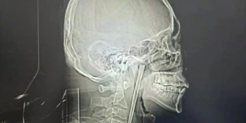 중국에서 한 남성이 길이 12㎝의 젓가락이 목에 박힌 채 8년을 버티다 제거 수술을 받았다. 사진 바이두 캡처